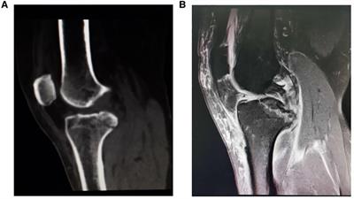 Frontiers | Study Of Double Button Plate And Cannulated Screw Fixation ...